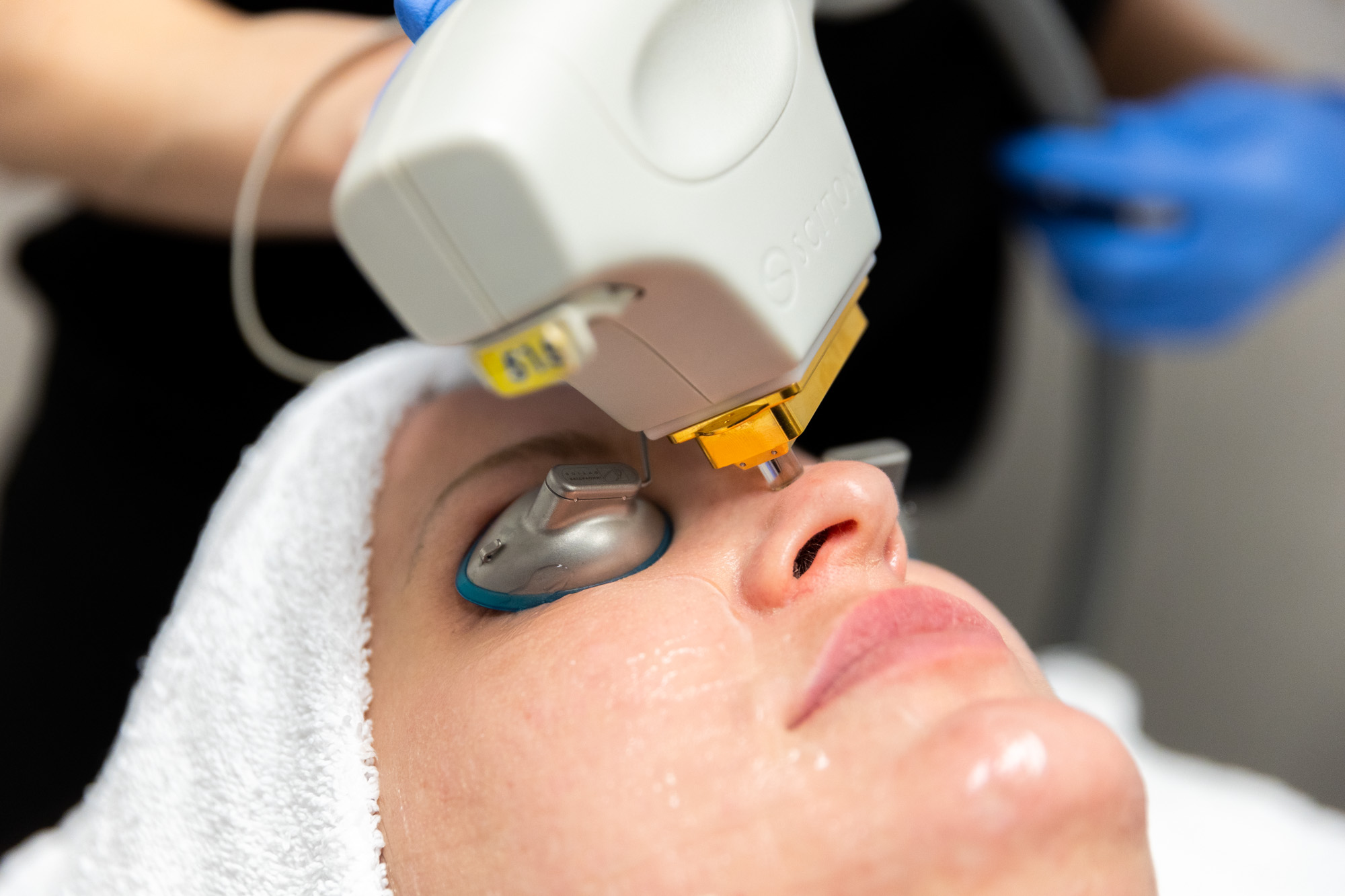 Close up of client receiving laser skin treatment on the bridge of their nose. They are wearing protective eye covers, and their face is covered in a thin layer of clear gel. Shot from right side of their face.