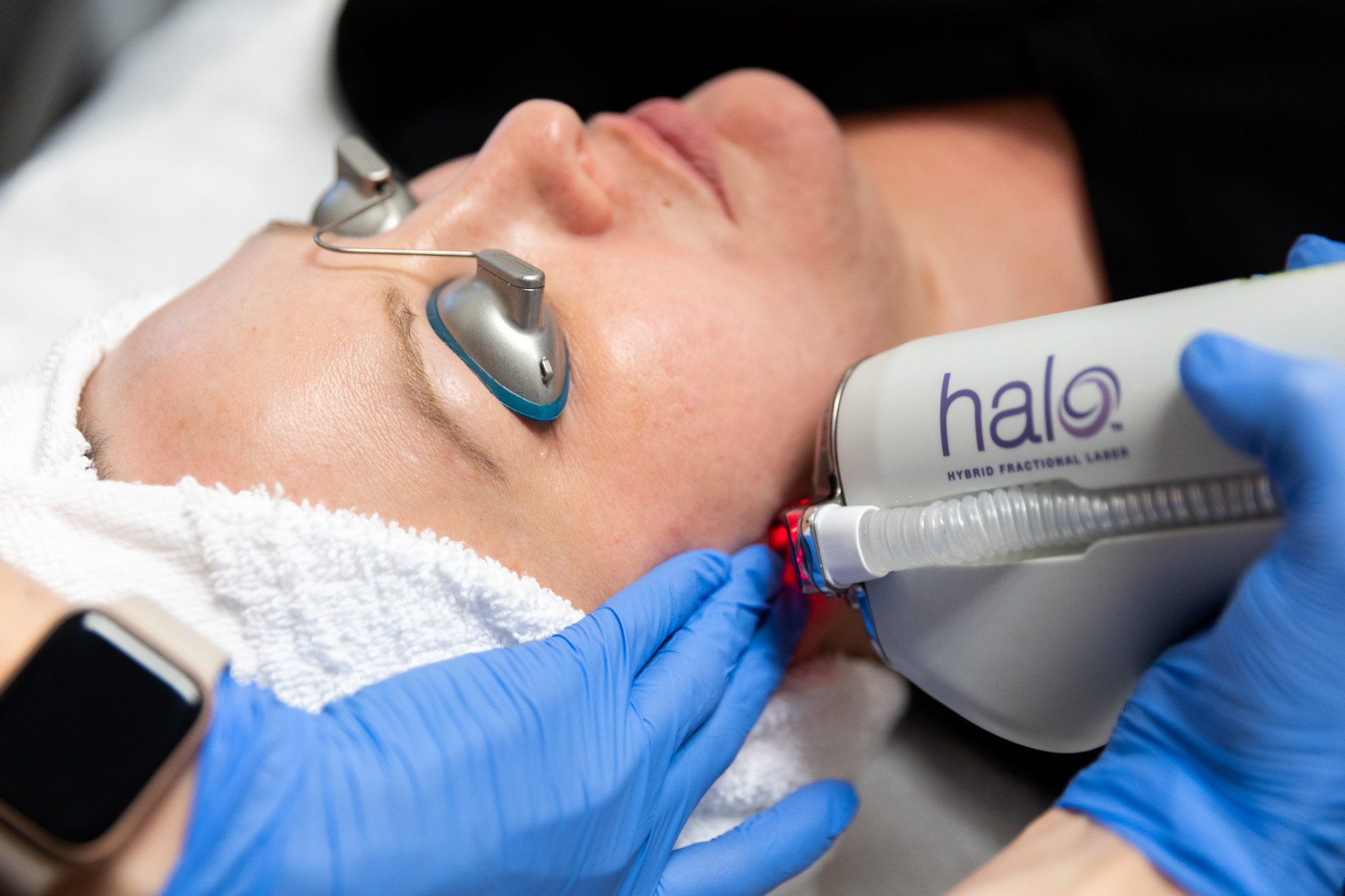 A Kansas City Skin and Cancer Center aesthetician holds the HALO treatment device against the female client's right jawline. The client is lying down with protective eye coverings on.
