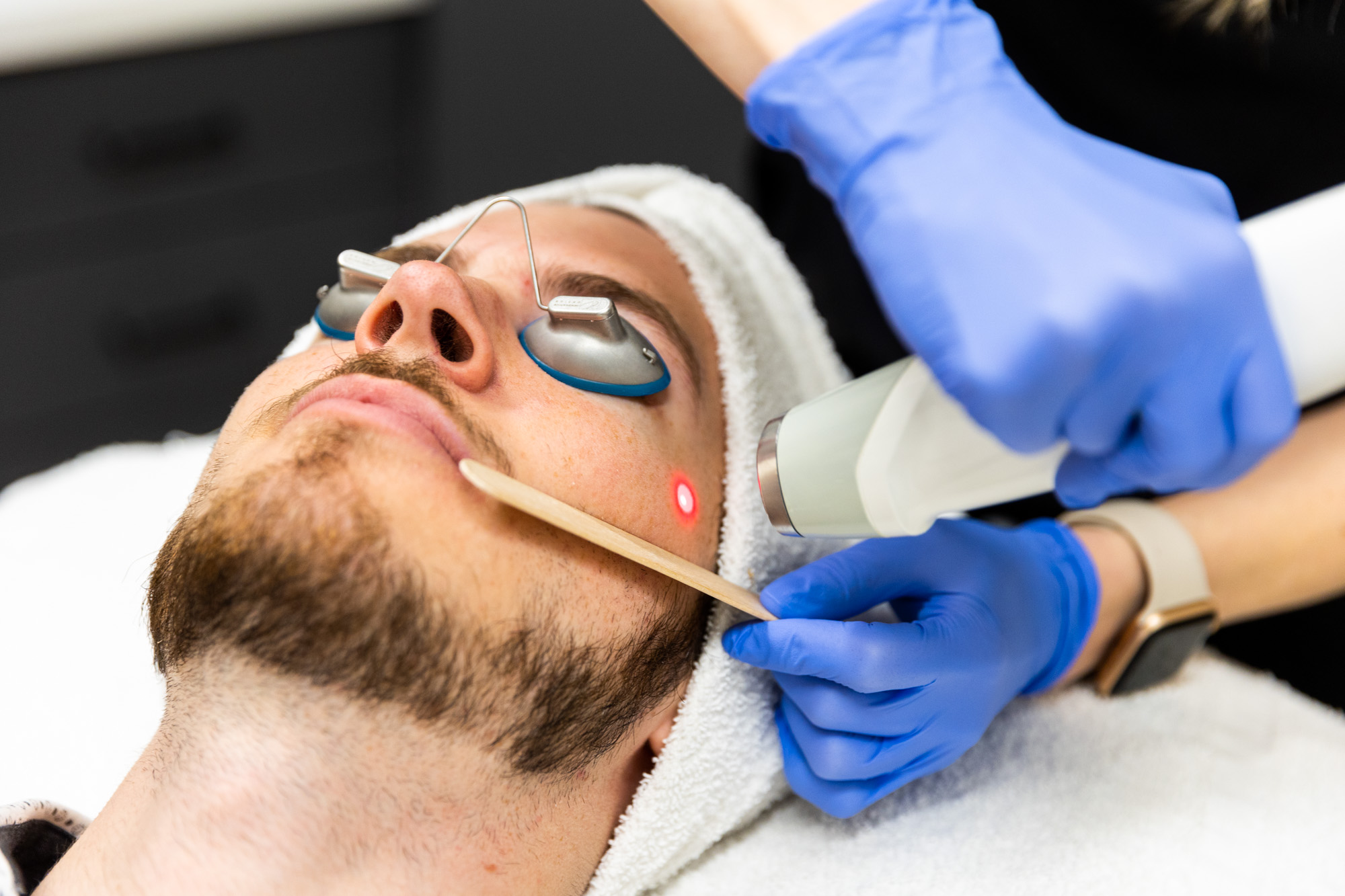 A male client is receiving the Laser Genesis treatment. His face is visible; he is wearing protective eye coverings and a towel over his hair. A medical professional holds the laser tool with one hand, then a popsicle stick along his cheekbone with the other.