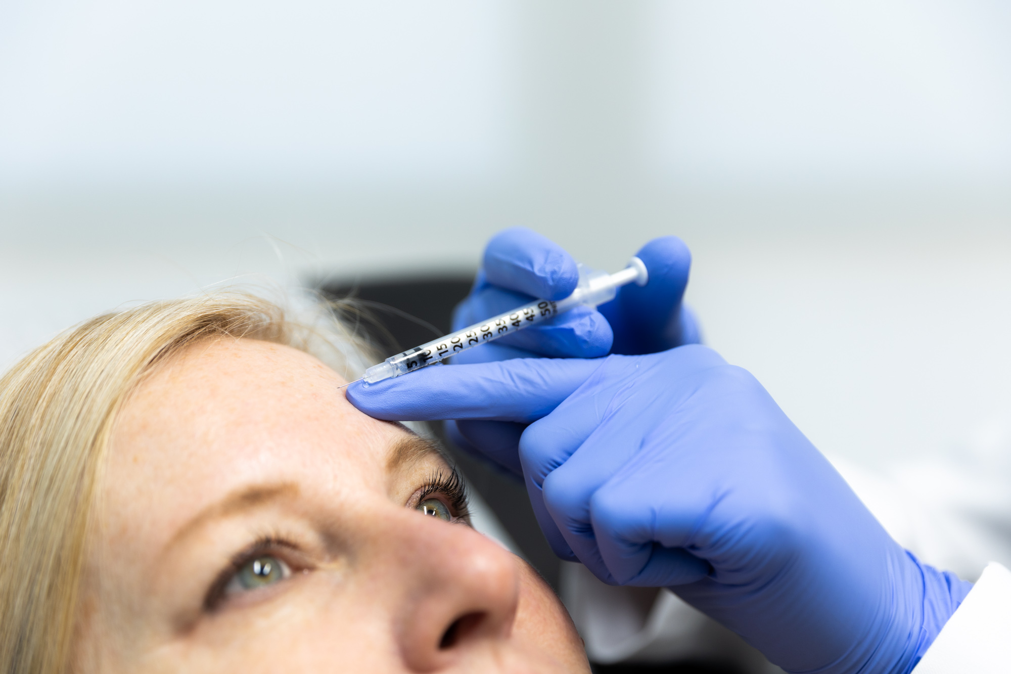 Close up of female patient receiving injectable treatment. Only her nose up is visible. Medical professional wearing blue gloves injects the needle into patient's forehead.
