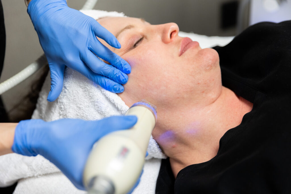 Shot from the side. A Kansas City Skin and Cancer Center professional holds the microneedling tool several inches from the client's face. Client is lying down with her eyes closed.