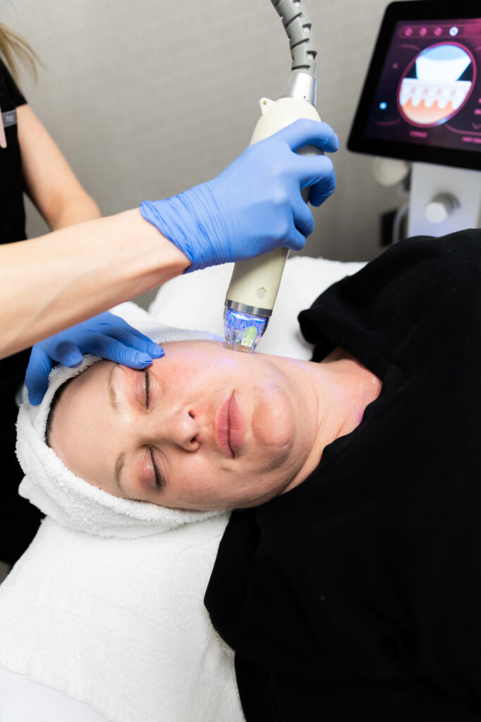 A patient relaxing as she receives her RF microneedling in Kansas City, MO. She is lying down as her provider carefully guides the handheld device over her cheek.