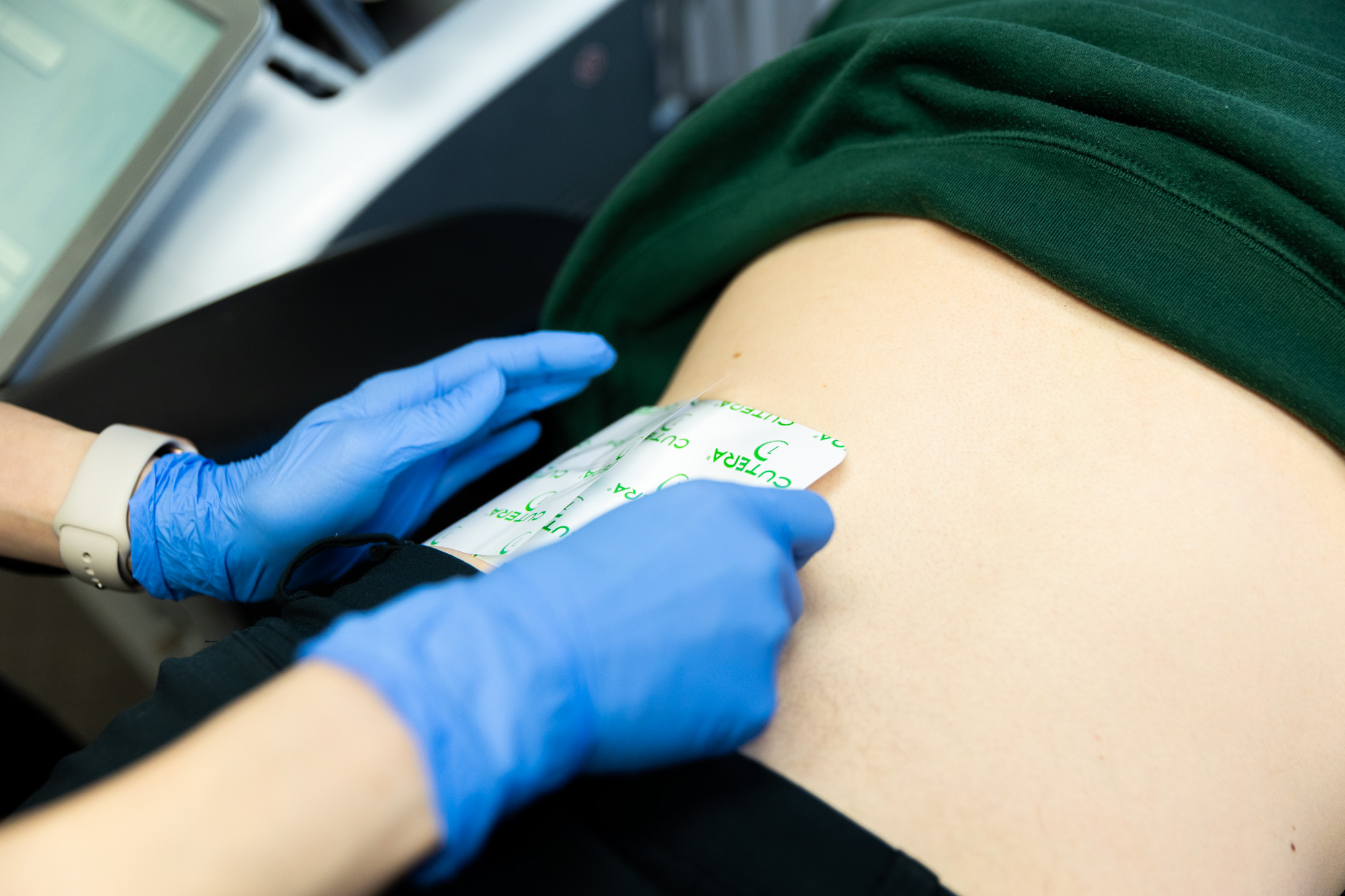 A close up shot of a Kansas City Skin and Cancer Center professional applying the Cutera preparatory sheet onto a patient's lower back.