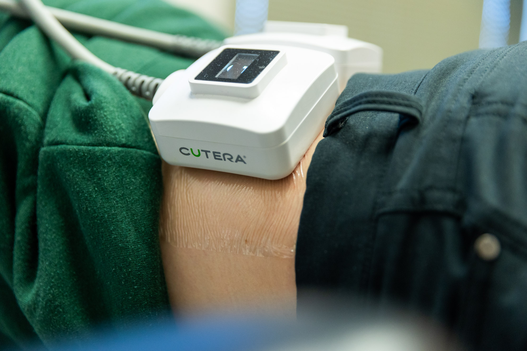 A close up shot of a medical device labeled CUTERA. It is placed on a patient's midsection. Patient is wearing a green top and black bottoms. Only the skin near the Cutera is exposed.