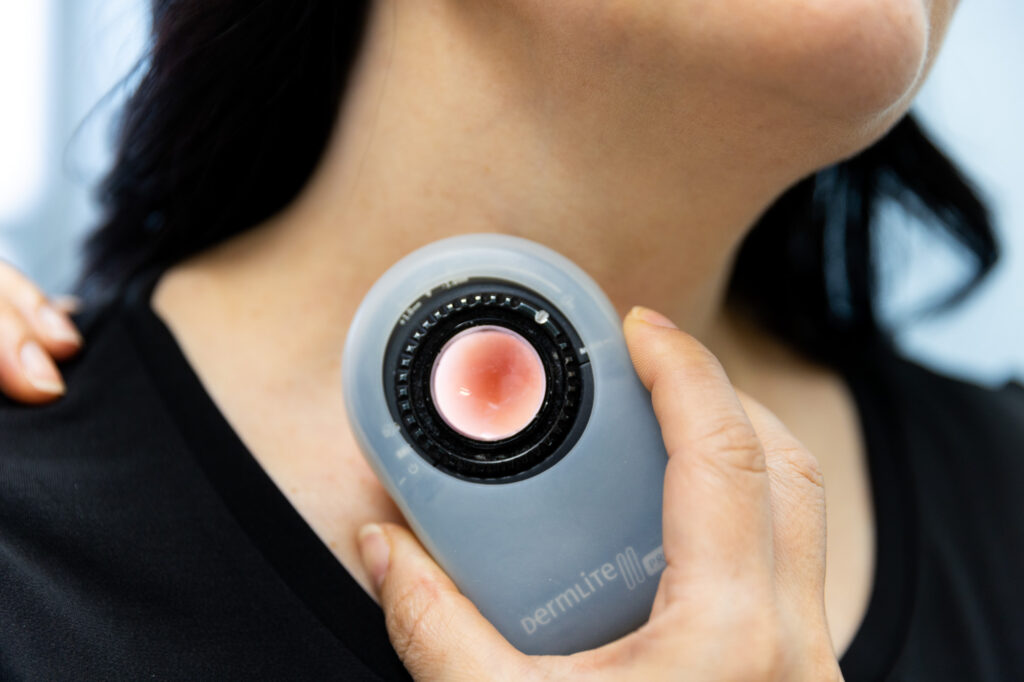 A provider uses a Dermlite magnifying device to assess a patient's skin growth. This will help them determine if the patient needs a skin cancer removal procedure in Kansas City.