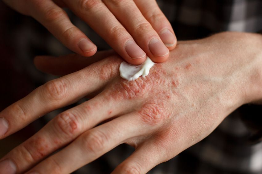 A patient with an eczema flare-up on the tops of their hands and knuckles. They are applying a medical-grade cream to the flare-up, which is a common eczema treatment in Johnson County, KS.